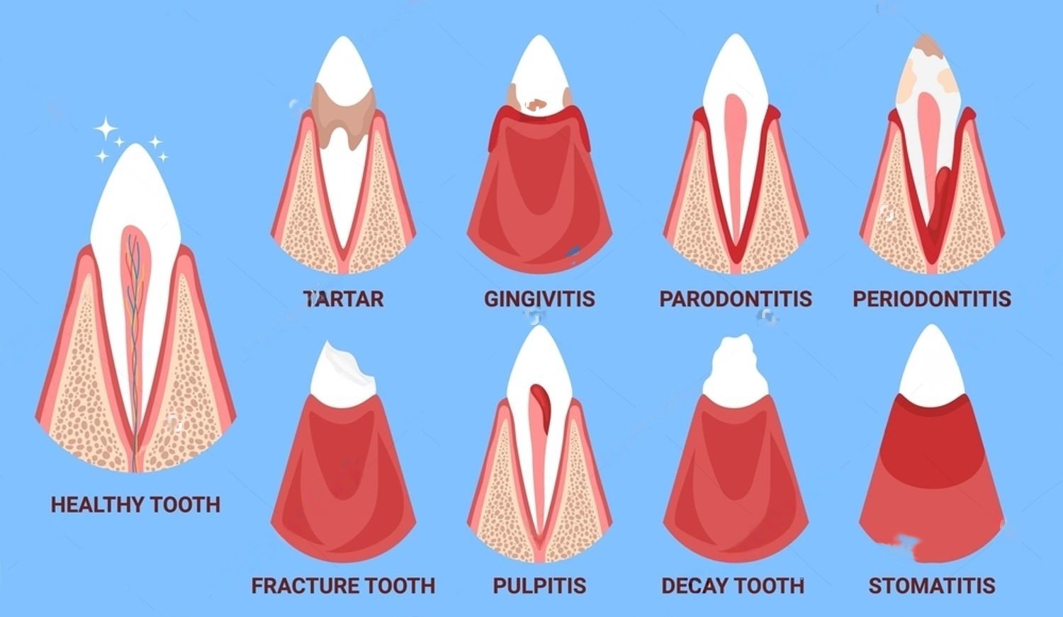 dog tooth decay stages